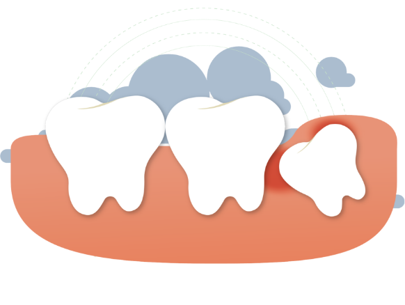 Wisdom Teeth extraction pasadena