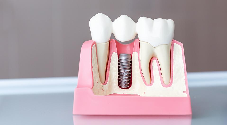 Who is a Candidate for Dental Implants?