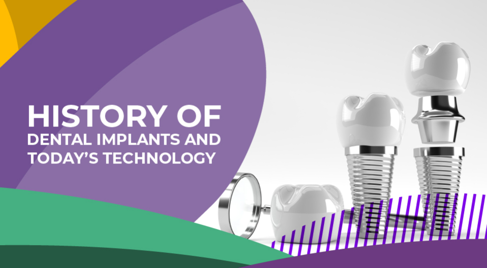 History Of Dental Implants And Today’s Technology