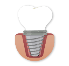 dental implants in Pasadena step 3